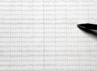 Nörofizyolojik bir muayeneden sonra elektroansefalogramın sonuçları. Beyin biyoelektrik aktivitesinin dinlenme, uyanıklık ya da uyku, elektroansefalografi ile kaydediliyor. 