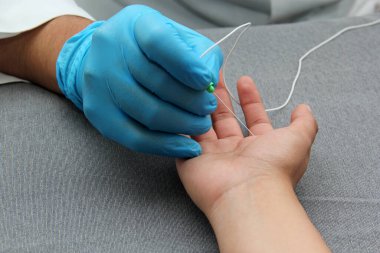 Electromyography is a graphic recording technique of the electrical activity of the muscles known as electromyogram or EMG, it is monitored through intramuscular electrodes