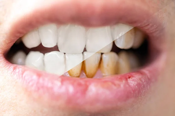 El primer plano de un hombre dientes antes y después del blanqueamiento. Concepto dientes de salud. —  Fotos de Stock