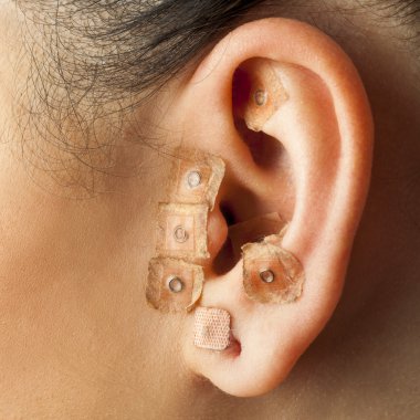 auriculotherapy insan kulak.
