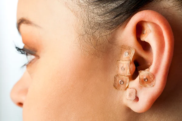 Auriculotherapie op vrouwelijke oor. — Stockfoto