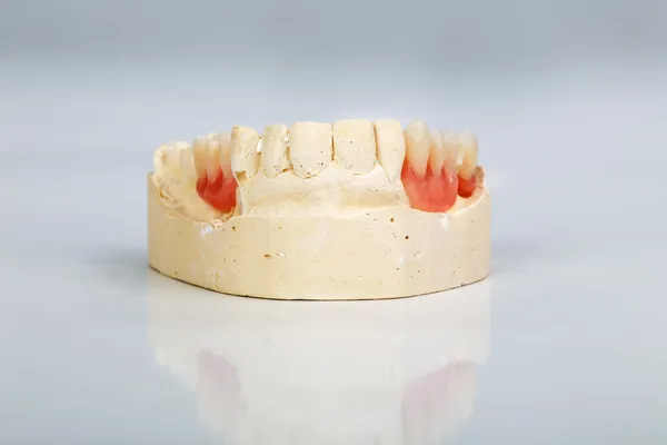 A partial denture mounted on a plaster study model — Stock Photo, Image