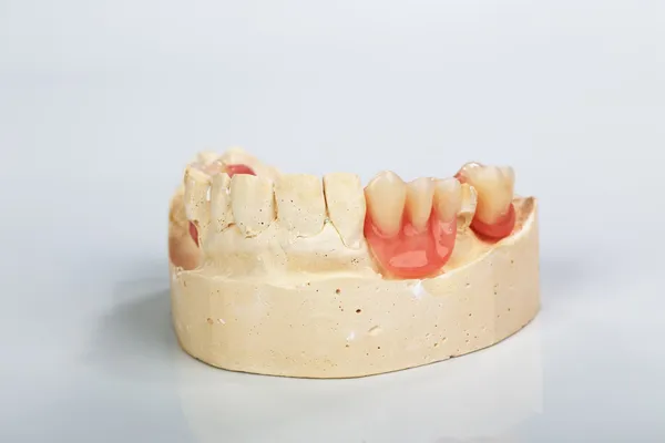 Částečná zubní protéza na sádrový model studie — Stock fotografie