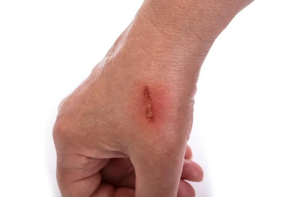 Burn Female Hand Cooking Pot White — Stock Photo, Image