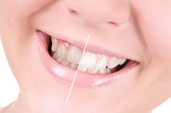 Clareamento dos dentes. Cuidados dentários — Fotografia de Stock