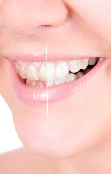 Teeth whitening. Dental care — Stock Photo, Image