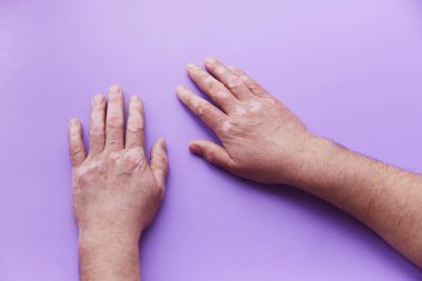 Mor arka planda vitiligo sorunlu eller görülüyor. Deri pigmentasyon sorunu. Yüksek kalite fotoğraf