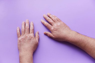 Mor arka planda vitiligo sorunlu eller görülüyor. Deri pigmentasyon sorunu. Yüksek kalite fotoğraf