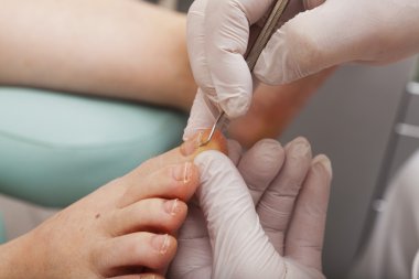 Chiropodists edited a toenail clipart