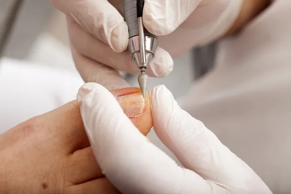 Chiropodist polishing — Stock Photo, Image