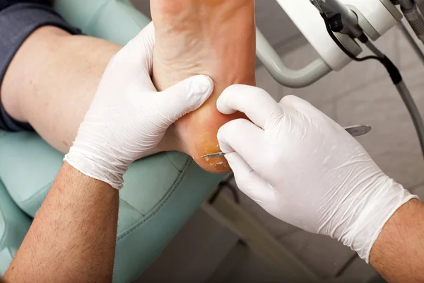 Removes dry skin on the sole of Foot — Stock Photo, Image