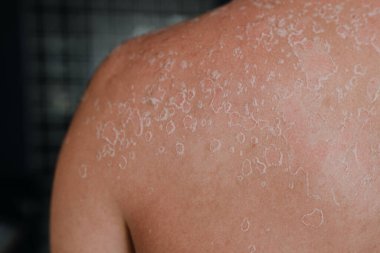 Dermatolojik koşullar, insanın sırtındaki ve omuzlarındaki derinin soyulması, deri ve cilt bakımı kavramı. Kapatın. Yüksek kalite fotoğraf