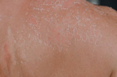 Deri dokusu, güneş yanığı ve insan vücudundaki alerjiden sonra pul pul hücre pulları. Yüksek kalite fotoğraf