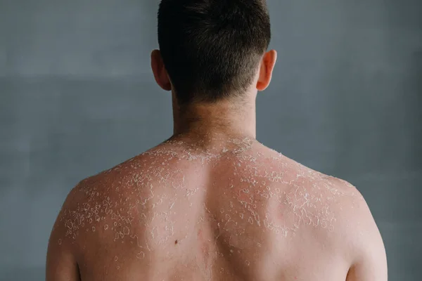 Dermatological conditions of peeling skin on man\'s back and shoulders, peeling skin and skin care concept. High quality photo