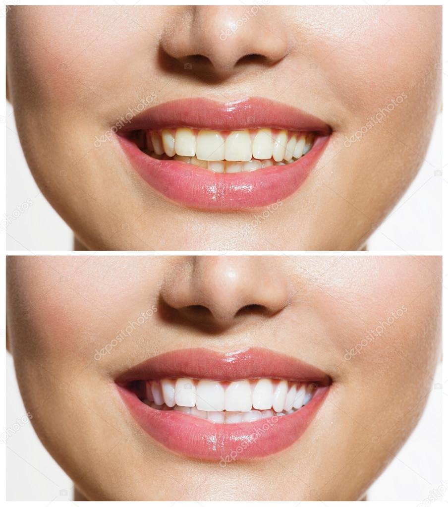 Woman Teeth Before and After Whitening. Oral Care