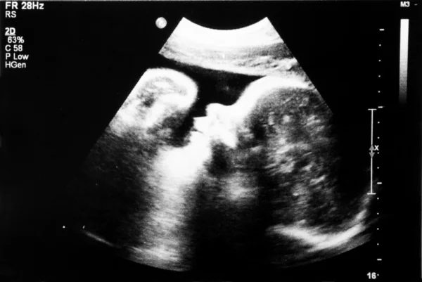 Fetus 5 month in the womb. — Stock Photo, Image