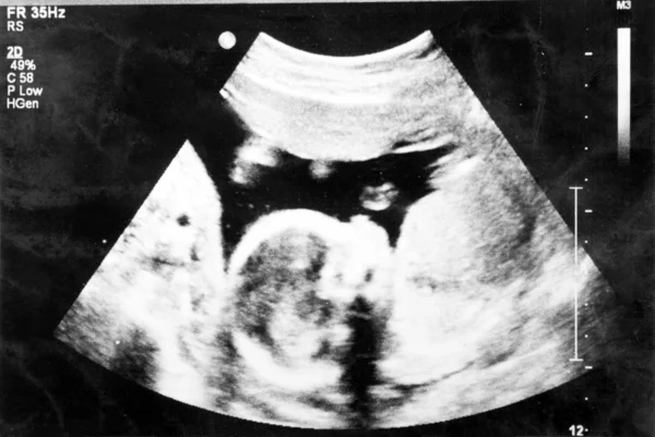 Feto 5 meses no útero . — Fotografia de Stock