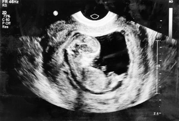 Fetus 5 month in the womb. — Stock Photo, Image