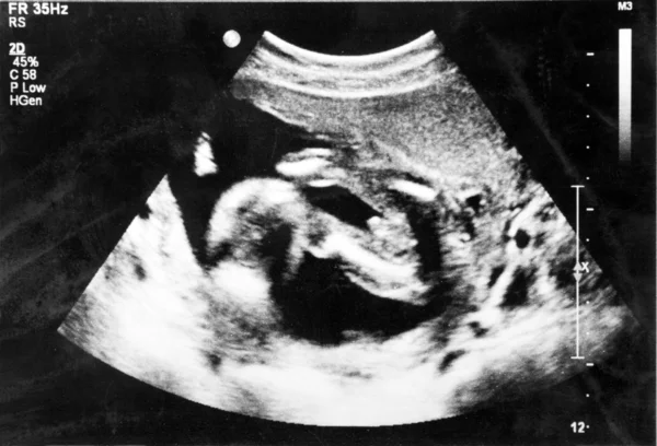 Fetus 5 month in the womb. — Stock Photo, Image