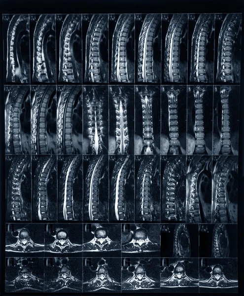 X-ray van de wervelkolom — Stockfoto