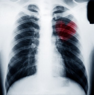 Göğüs xray