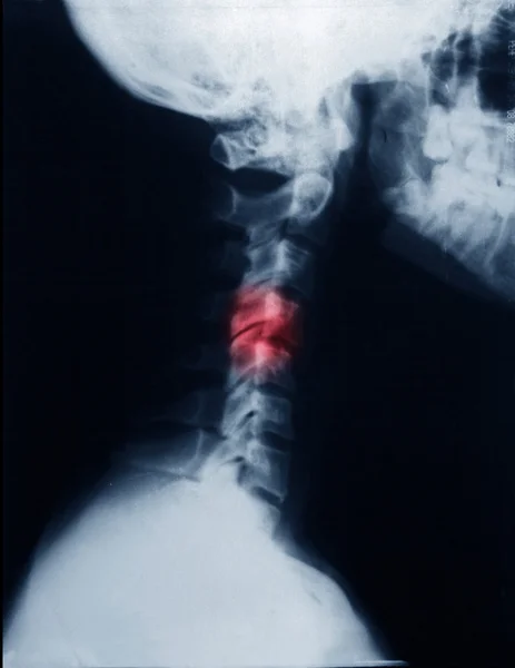 Peça humana de crânio e coluna vertebral (vértebra cervical  ) — Fotografia de Stock