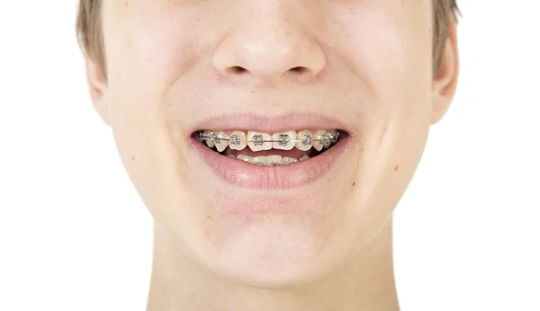 Ортодонтические брекеты — стоковое фото
