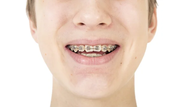 Appareils orthodontiques — Photo