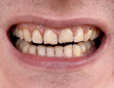 Çarpık sarı dişli, gülümseyen bir adam. Sağlıksız dişler dişçilikte tedavi gerektirir. Bruksizm