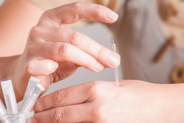 Needeling Acupuncture — Stock Photo, Image