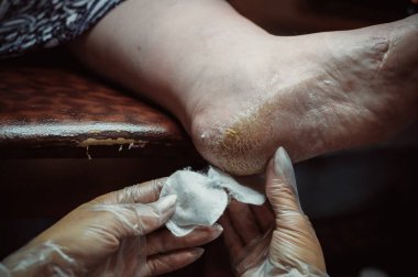 Pedicurist softens skin of client's heels with cotton pads