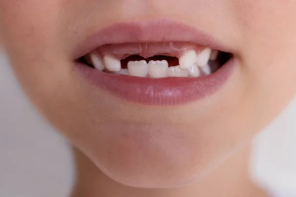 Primer Plano Boca Niño Sin Dientes Delanteros Leche —  Fotos de Stock