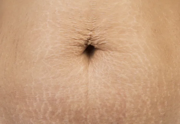 Stretch Marks — Stock Photo, Image