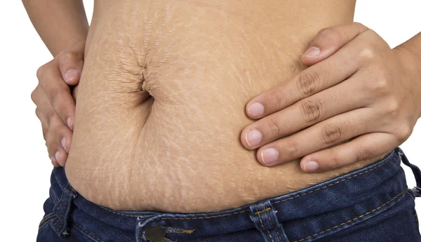 Stretch Marks — Stock Photo, Image