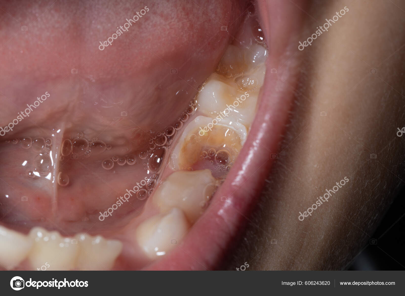 欺负牙齿的细菌图片素材-编号24870514-图行天下