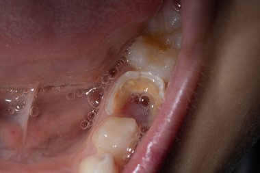 Bir çocuğun dişinde delik, diş bakımı ve hastalık yüzünden diş tahribatı.