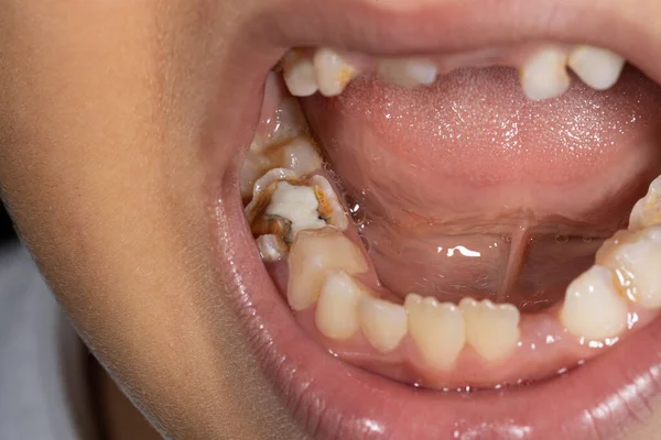 Ein Loch Kinderzahn Zerstörung Eines Zahnes Durch Karies Und Krankheit — Stockfoto