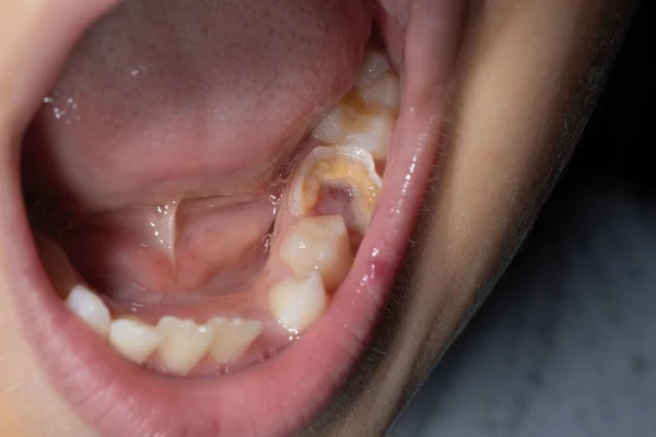 歯の穴歯のケアと病気による歯の破壊 — ストック写真