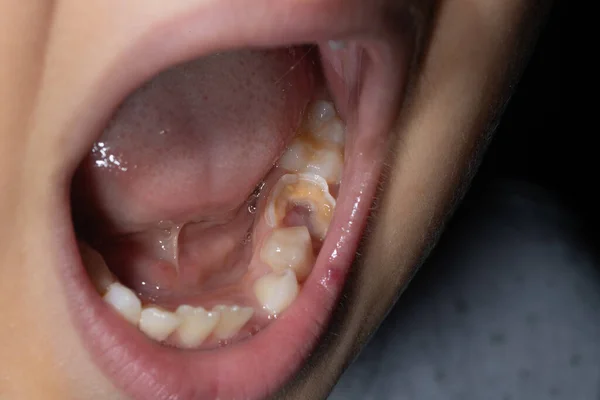 Trou Dans Dent Enfant Destruction Une Dent Par Carie Dentaire — Photo