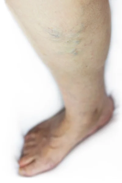 Varicose veins — Stock Photo, Image