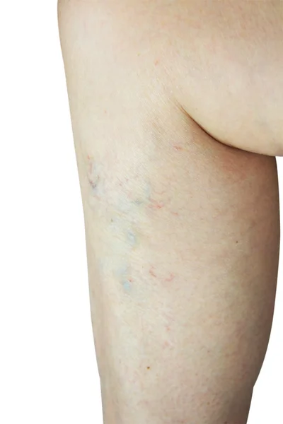 Varicose veins — Stock Photo, Image