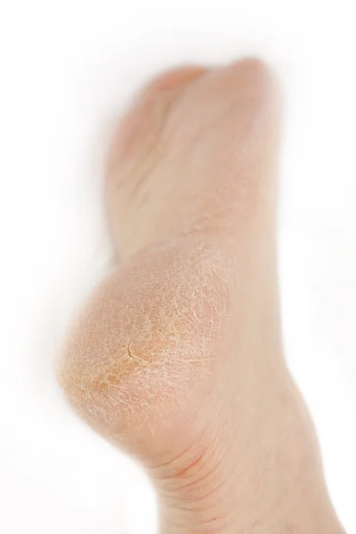 Cracked foot — Stock Photo, Image