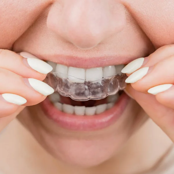 투명 한 플라스틱 리시버를 입은 여성의 클로즈업 사진. 한 소녀가 치과 기구를 사용하여 물린 자리를 교정 한다 — 스톡 사진