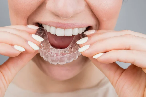 Close-up portrait of a woman putting on a transparent plastic retainer. A girl corrects a bite with the help of an orthodontic device — Stock Photo, Image