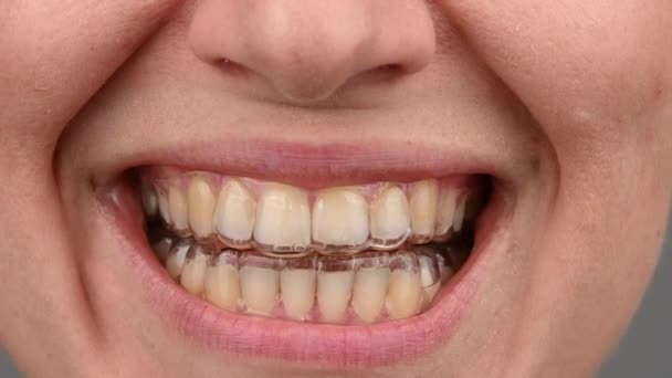 Primer plano de una mujer caucásica sonriendo con alineadores en los dientes. Macro. — Vídeos de Stock