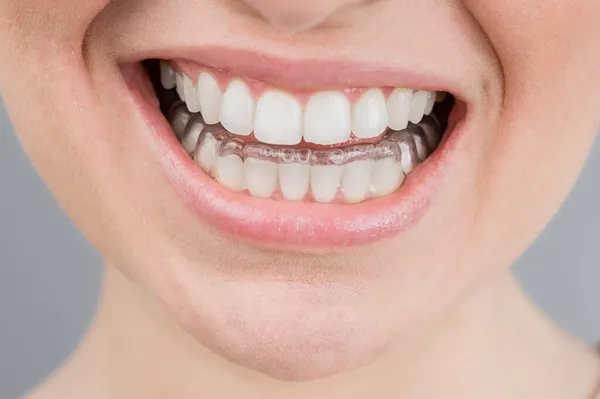 Close-up portret van een vrouw die een doorzichtige plastic beugel opzet. Een meisje corrigeert een beet met behulp van een orthodontisch apparaat — Stockfoto