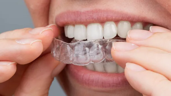 Λευκή γυναίκα φοράει αλεξιπτωτιστές. Ορθοδοντική συσκευή ισιώματος δοντιών. — Φωτογραφία Αρχείου