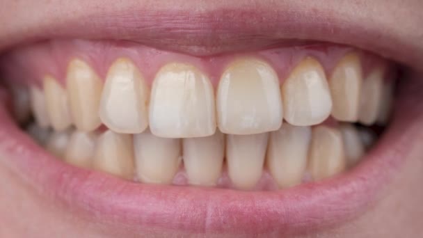 Primer plano de una sonrisa de las mujeres antes y después del blanqueamiento de dientes. — Vídeo de stock