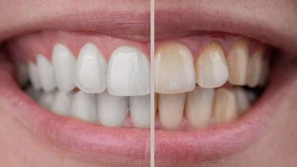 Zbliżenie kobiet uśmiech przed i po wybielaniu zębów. — Zdjęcie stockowe