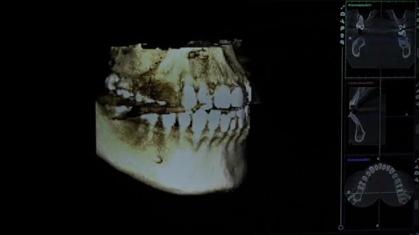Modelo 3d de una imagen de rayos X de una mandíbula humana. Programa informático para imágenes dentales — Vídeos de Stock